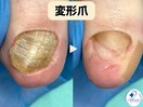 変形・肥厚した爪を正常な爪へ