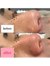 エリー(ERIE)/艶肌WAX × グローパック