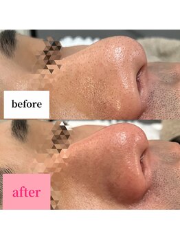 エリー(ERIE)/艶肌WAX × グローパック