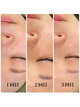 ラシック(Rachic)/剥離なしハーブピーリング