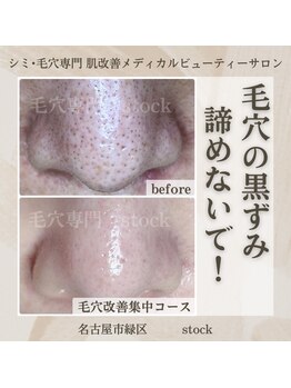 ストック(stock)/毛穴の黒ずみ諦めないで！