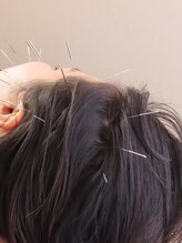 しおはりきゅう(SHIOはりきゅう)/頭皮の鍼は頭の疲れもスッキリ！
