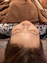 ハリファ鍼灸院 横浜関内院(HariFa鍼灸院)/美容施術/美容鍼