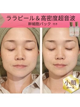 リムビューティー 自由が丘(RymBeauty)の写真/麻布十番の実績店が自由が丘へ！【期間限定キャンペーン】水光リフト+ララピール+幹細胞パックで最短小顔