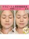 リムビューティー 自由が丘(RymBeauty)の写真/麻布十番の実績店が自由が丘へ！【期間限定キャンペーン】水光リフト+ララピール+幹細胞パックで最短小顔