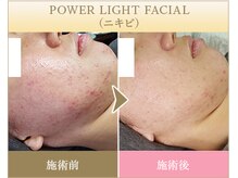 ビューティースペース 品川大井町店(Beauty Space)/光フェイシャル