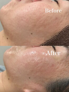 ツール(TOOL)/ハーブピーリング