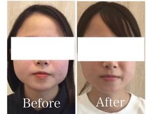 サロンベイビー 西宮本店(Salon Baby)/小顔人気No.1 小顔美容整顔