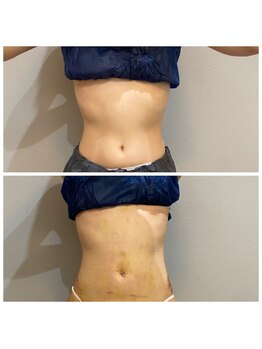 サロンシファ(salon sifa)/術前インディバ