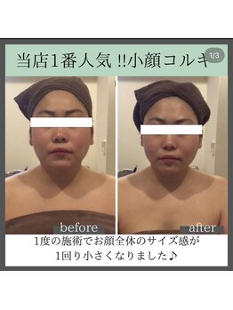 トータルビューティーサロン レビュー(REVIEW)/【Before/After】小顔コルギ