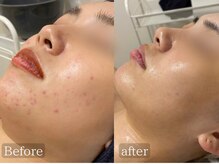 ホーミー(Homie)/ニキビ改善、赤みニキビ改善