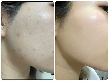 リノア(Lino'aka)/セルマントリートメント