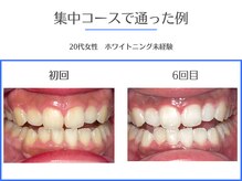 エクシアホワイトニング 岡崎店/低価格で確実に白くなるサロン★