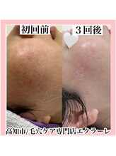 エクラーレ(Eclale)/マリムーブフェイシャルワックス