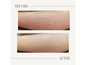 カッツ 宮通り(CUTS)/CUT'Sハイブリット脱毛