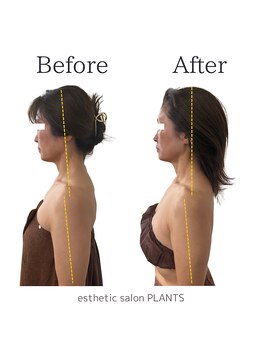 プランツ(PLANTS)/60代／２回／たるみ・首肩凝り