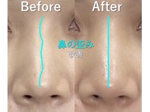 ラプリ 横浜店(Raplit)/隆鼻＋輪郭矯正40分10回