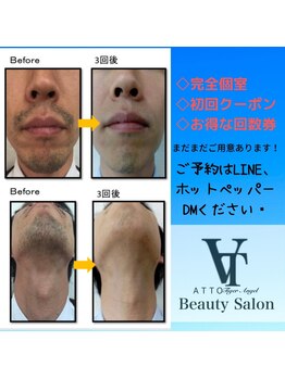 アット(ATTO)/青髭卒業!!!