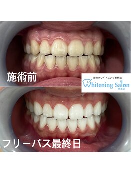 ホワイトニングサロン 熊本店/セルフホワイトニンング