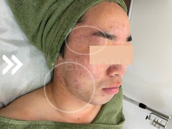 グリーンピール エルモナ(GREENPEEL ELMONA)/【グリーンピール5Days】