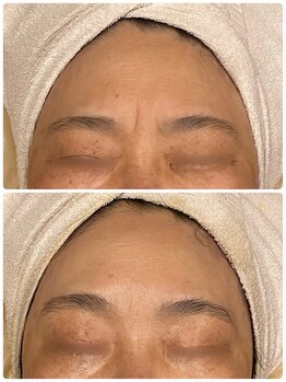 ベルミナ(BE.LMINA)/眉間のシワへアプローチ