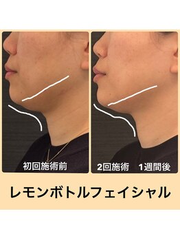 モカ(MOKA)/レモンボトルフェイシャル