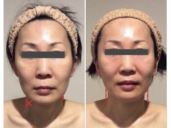 TKC 東京小顔センター五反田店の写真/最短2ヶ月で小顔に！オリジナル小顔矯正でゆがみ、左右差、人中長改善！男女可◎イベント・ブライダルにも