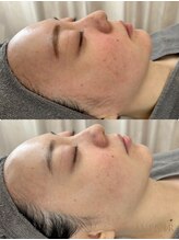 アベニール 芦屋/赤み/皮脂/メイク崩れ