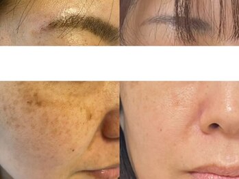 シミケア専門店 SAKURA 平塚店/平塚ハーブピーリング