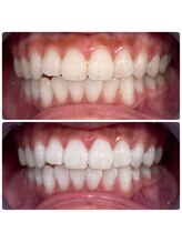 エクシアホワイトニング 日本橋店/成人式ホワイトニング