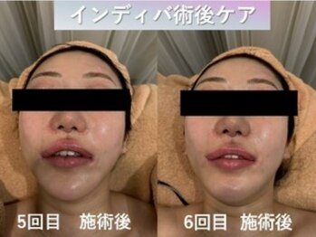 ラディアント(Radiant)/インディバ術後ケア/肌質改善