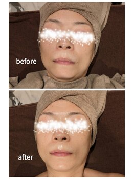 リジューブ(Rejuve)/プラズマ+CARBOXYパック