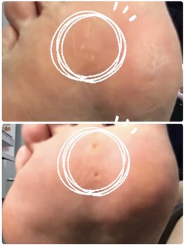 ラリベルテ(La liberte)/魚の目