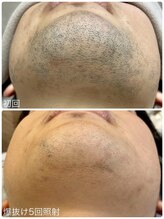 ヒスイ バイ アメイジング(Hisui by AMAZING)/【光脱毛】男性髭　IPL &nbsp;&nbsp;爆抜け