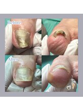 巻き爪補正店 大阪梅田駅前店/巻き爪ケアで爪色までキレイに！