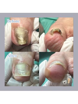 巻き爪補正店 大阪梅田駅前店/巻き爪ケアで爪色までキレイに！