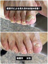 巻き爪じゅん 千葉駅前店/橋市で肥厚爪の厚みが気になる方