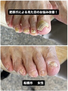 橋市で肥厚爪の厚みが気になる方
