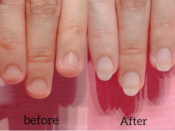 ネイル クロス ラニ 所沢店(Nail×Lani)/もう隠さない深爪矯正／所沢