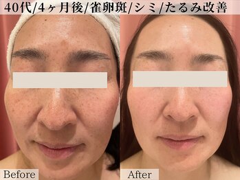 ベルタ(BELTA)/ケア前→4ヶ月後　シミ/雀卵斑