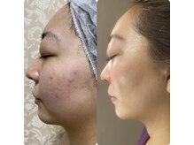 マナ(mana)/ニキビ肌できてしまった凸凹に◎