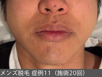 オアシスラグーン(OASIS LAGOON)/メンズ脱毛(症例11 施術20回)
