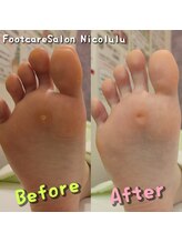 ニコルル 大阪天満店(Nicolulu)/繰り返す魚の目ビフォーアフター