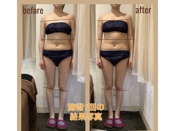 レアフィート(Rheafeet)/症例写真です。