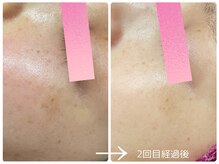 フォーチューン/シミの改善トータルケア