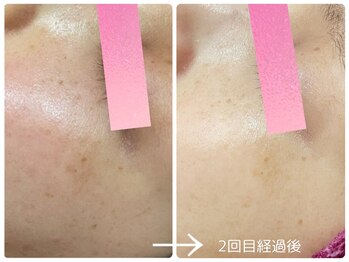 フォーチューン/シミの改善トータルケア