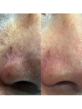 クラスペディア 嘉島店/角栓・イチゴ鼻・毛穴開き