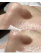 オプレア 千種店(OPREA)/【比較写真】毛穴洗浄