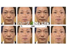 ワン(ONE)/ハーブピーリング