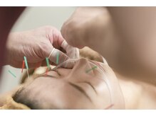 中島整骨院 鍼灸院 整体院/美容鍼と水素吸引です